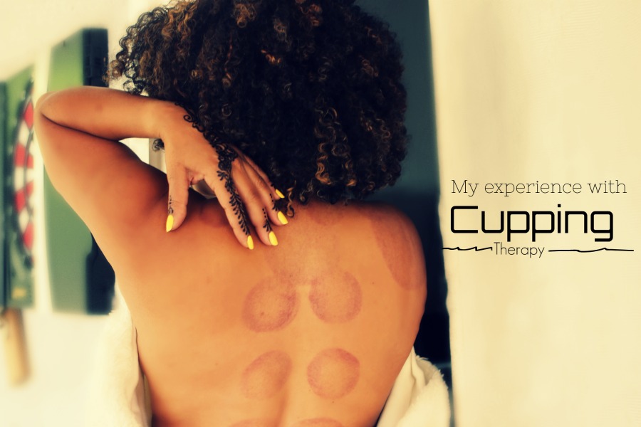 My Experience With Cupping For Lower Back Pain
